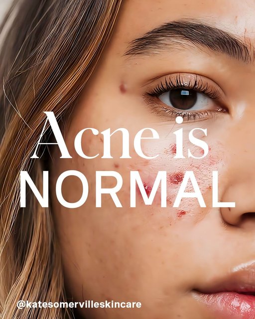 We know firsthand how acne can affect your confidence + mental health. It can feel isolating, frustrating, even defeating. But please remember: it doesn’t define you🫶

This Acne Awareness Month, we’re showing up with honesty + compassion – no filters, just real people + real results.

If you’ve ever struggled with acne (past or present) comment below kind word or piece of advice help create a space where others feel seen + supported💖

#KateSomerville #AcneAwarness #AcneIsNormal #RealPeopleRealResults #AcneCommunity #SkinConfidence