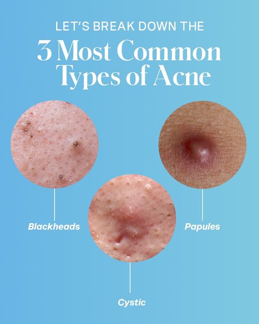 Let’s talk about acne – because not all breakouts are the same ✍️⬇️

✨ Blackheads: Tiny clogged pores that appear as dark dots (don’t pick them, please 😭)
✨ Cystic: Deep, painful bumps under the skin that can take longer to heal
✨ Papules: Small, inflamed red bumps that can feel tender to the touch

BONUS: No matter what type of acne you’re dealing with, hydration + gentle exfoliation are still key. Our ExfoliKate Glow Moisturizer is acne-prone safe, delivering a healthy, glow without clogging pores 💚✨

Still not seeing the results you want? It might be time for acne-targeted treatments at a skin clinic – preferably the @katesomervilleskinclinic in West Hollywood💅🌴

#katesomerville #acneproneskin #acnefighter #sulfur #acnejourney #acne101 #blemishfighter #healingskin
