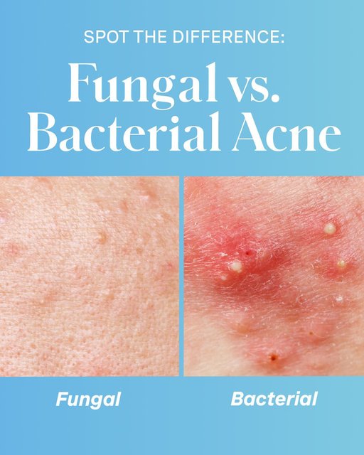 Persistent acne? Let’s make sure you know what you’re dealing with✍️
 
Fungal acne + bacterial acne can look similar on the surface, but understanding what’s happening underneath can help you manage breakouts more effectively🔎
 
The good news? Our EradiKate 3% Sulfur Cleanser + EradiKate 10% Sulfur Acne Treatments help with BOTH types of acne💖 Swipe to learn how to tell them apart + which other products we recommend specifically for bacterial acne to get your skin back on track🧴✨
 
Shop this acne-fighting lineup now on KateSomerville.com or online + in-store @UltaBeauty 🛒
 
#KateSomerville #AcneProneSkin #AcneJourney #FungalAcne #BacterialAcne #Sulfur #AcneFighter