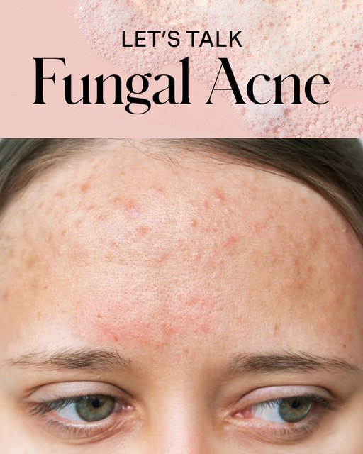 Do you think you might be the victim of fungal acne? 🔎  Swipe to uncover the facts + get back on track to clear, healthy skin 💖 
 
Shop these two anti-fungal MVPs now on KateSomerville.com or online + in-store at @UltaBeauty 🛒 
️ 
#KateSomerville #EradiKate #AcneTreatment #SkincareThatWorks #RealResults #UltaBeauty